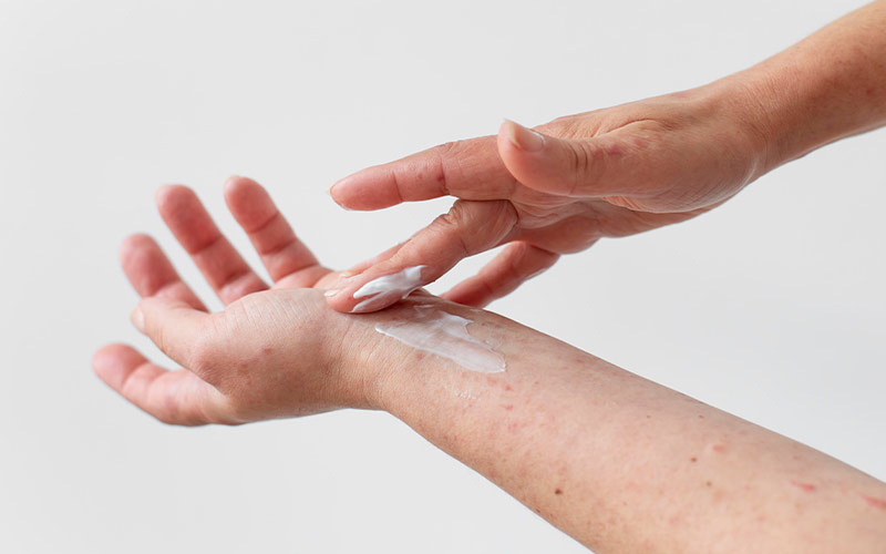 ATOPİK DERMATİT TEDAVİSİ