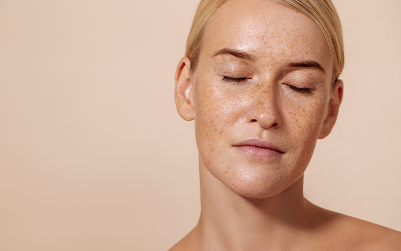 CİLT LEKELERİ TEDAVİSİ