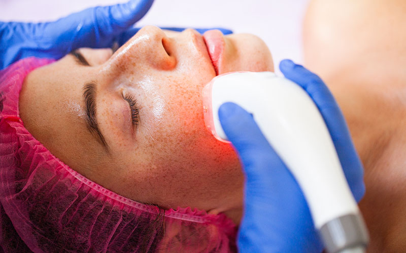 LAZERLE KIRMIZI YÜZ TEDAVİSİ