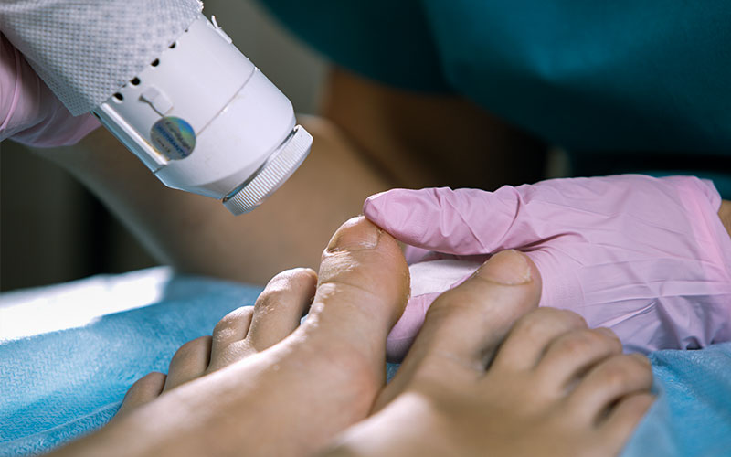 LAZERLE TIRNAK MANTARI TEDAVİSİ