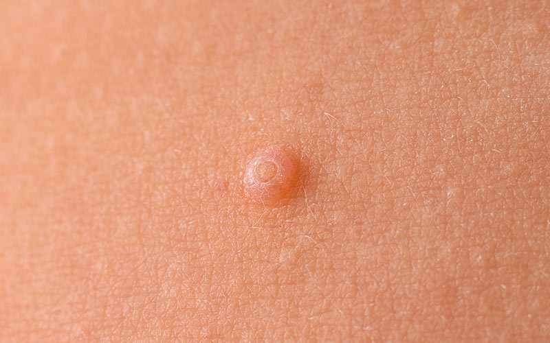 MOLLUSKUM KONTAGIOZUM TEDAVİSİ