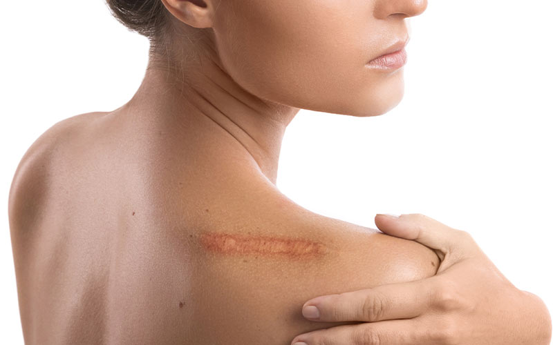 SKAR İZLERİYLE ÖMÜR BOYU YAŞAMAYA MAHKUM MUYUZ?