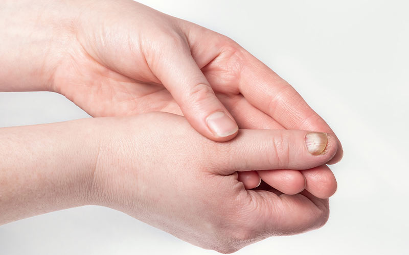 TIRNAK HASTALIKLARI TEDAVİSİ